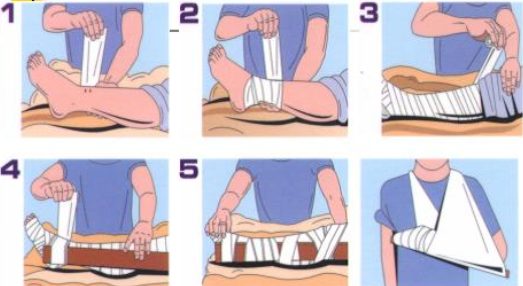 Băng nẹp ép bất động chi bị rắn cắn.