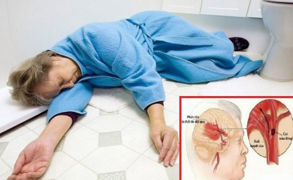 Nguyên nhân gây đột quỵ