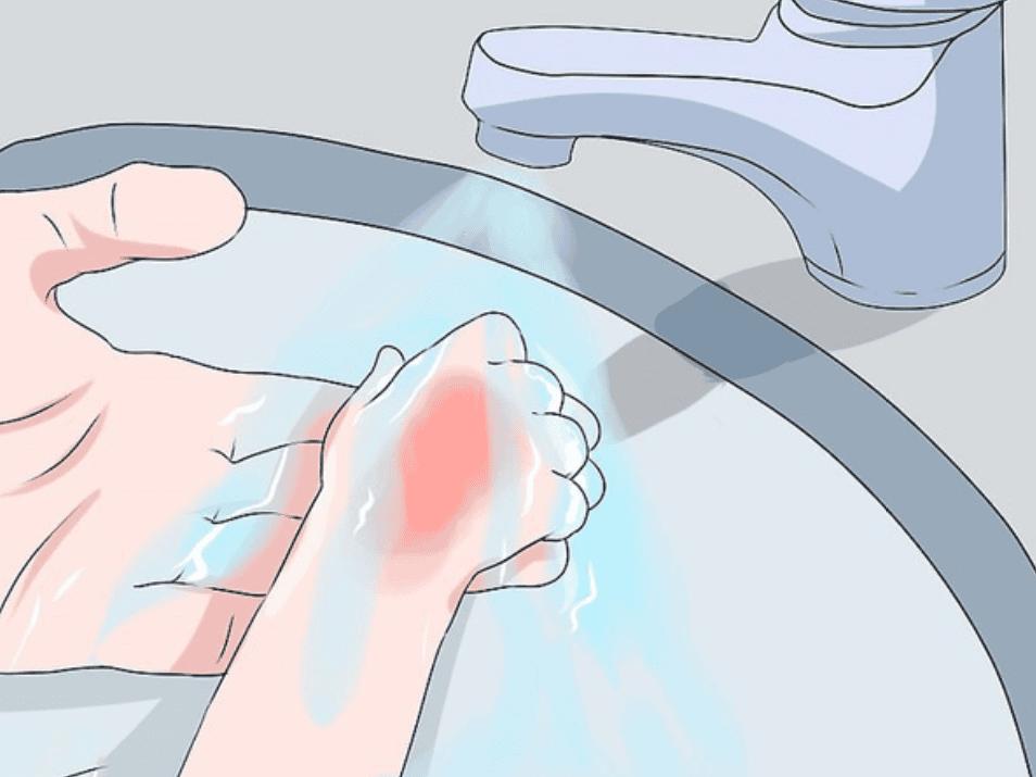 Cách sơ cấp cứu bỏng do hóa chất