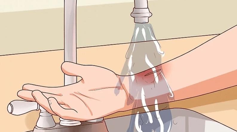 Cách sơ cứu khi bị bỏng dầu ăn